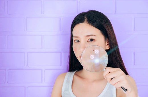 ความเชื่อผิดๆ เรื่องสิวที่ควรถูกแก้ไข